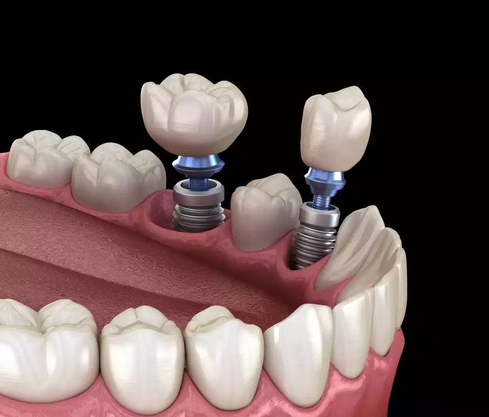 Why Opt for Titanium Tooth Replacement Solutions?