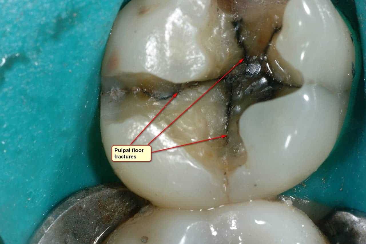 Cracks in teeth often originate in stresses from silver fillings
