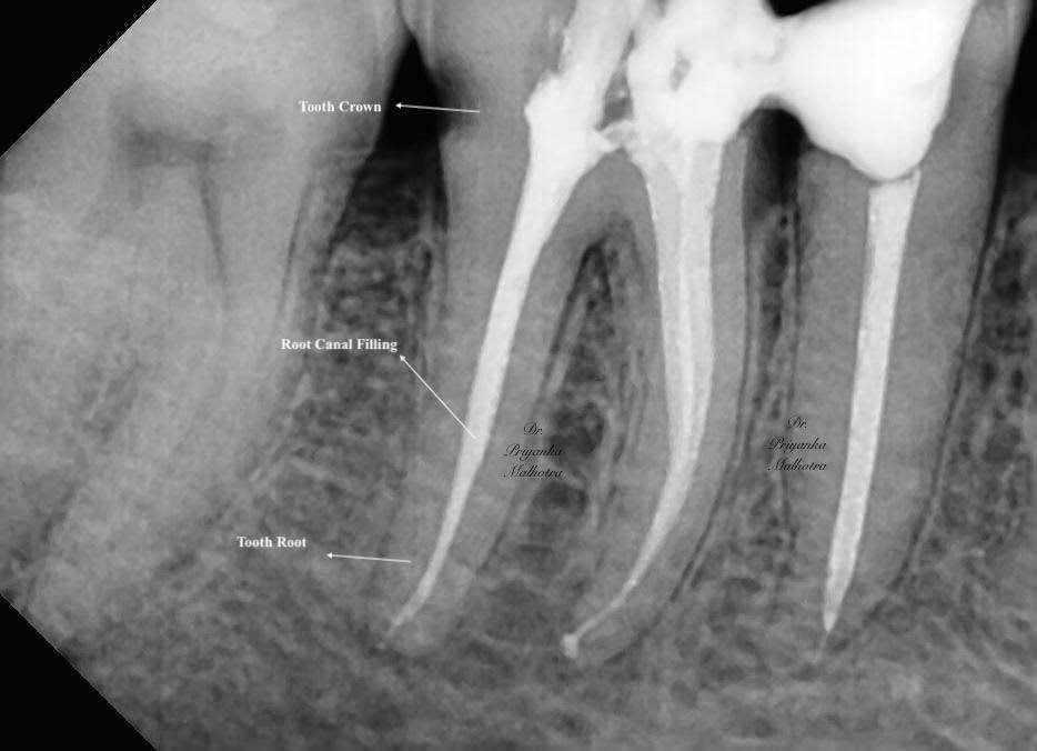 Root Canal Infection Xray