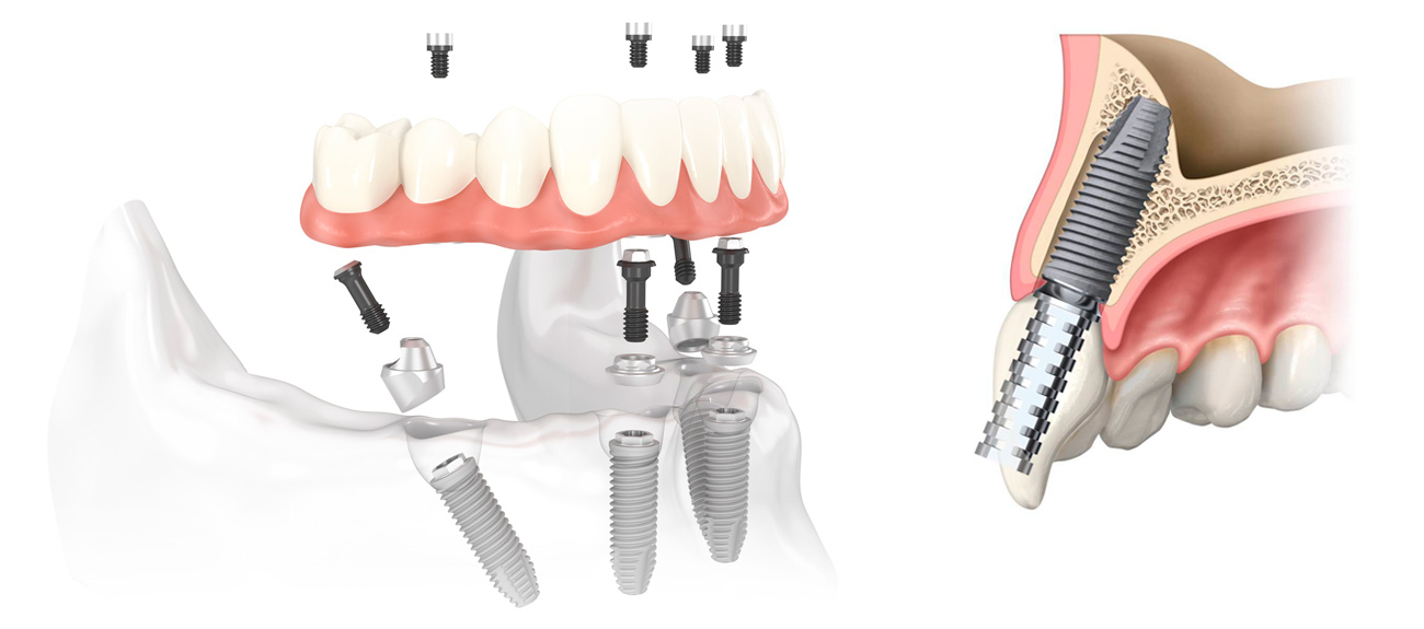 How Much Does Dental Work In Mexico Cost? What Are The Prices? Dental