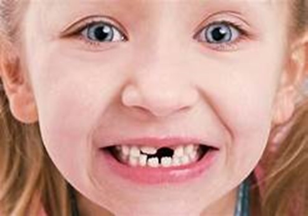 Taking Care of Milk Teeth Why are They Important? dentalimplantindia