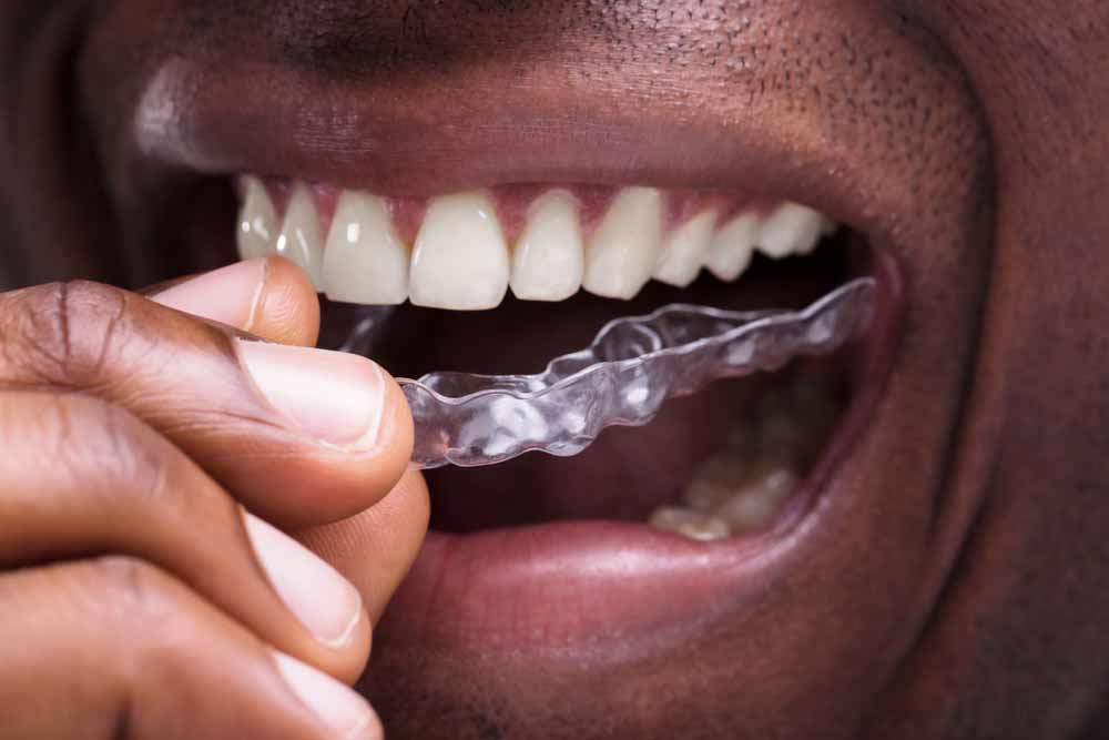 Invisalign Braces Dental Implants and Braces Clinic Nairobi