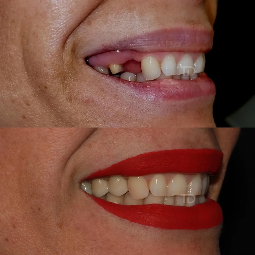 Emax dental bridge Dental Implants cost Abroad Uk dental tourism source