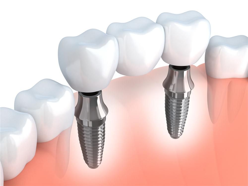 Tooth Implants Aftercare Tips DENTAL IMPLANTS SYDNEY