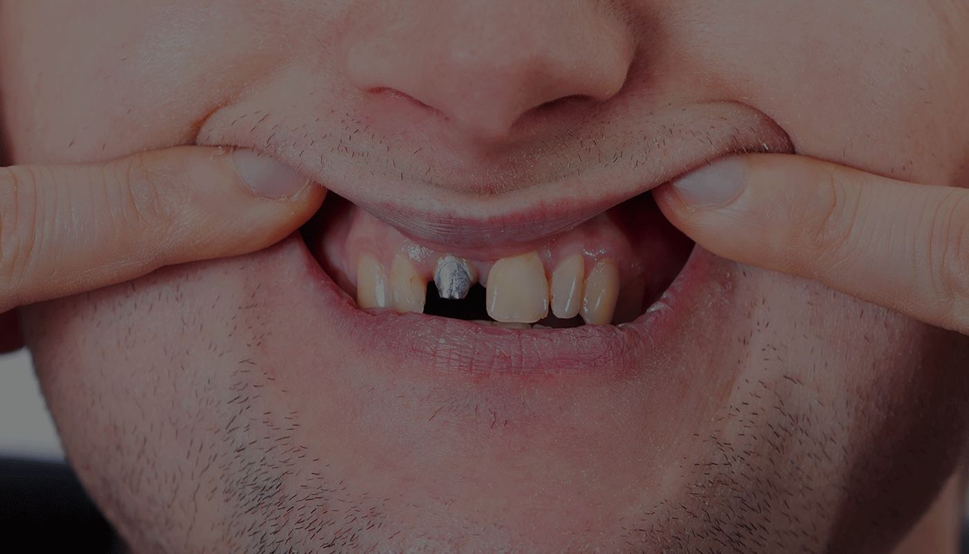 Do Any Dental Plans Cover Implants VIP Dental Implants