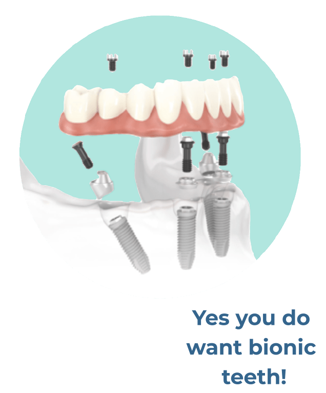 FullArch Dental implants Dental Implants GPS
