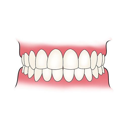 Essix Partial Denture Retainer Dental Lab Direct