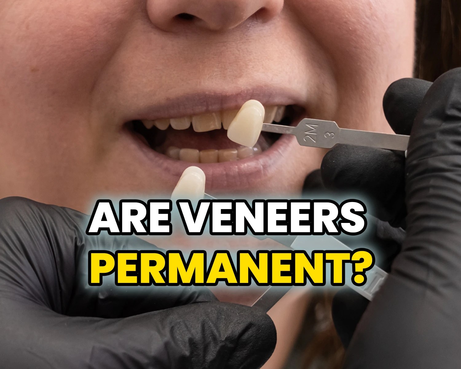 Permanent Dental Veneers The 8 Most Important Points to Know