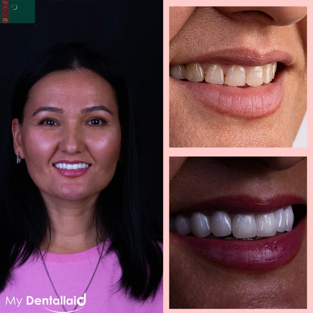 Cheapest Country for Dental Work in The World