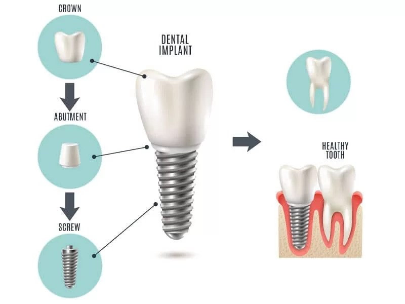 Implant Crown Cost In Mexico Implant Crown Price Dental Guide