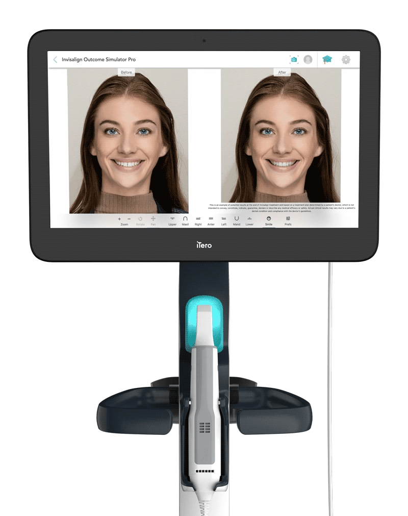 Ortodoncia Invisible Invisalign en Chile Clinica Dental Naran