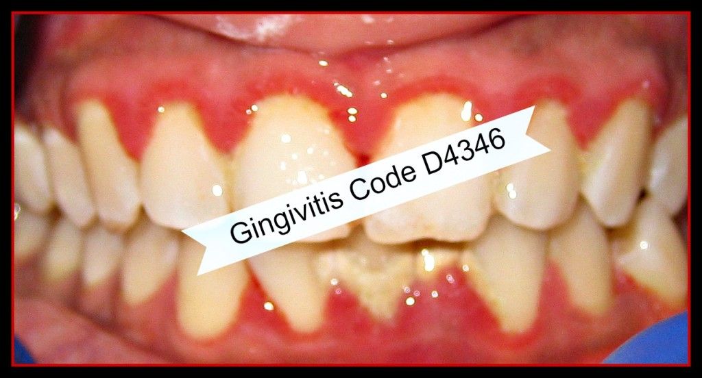 Gingivitis Code What You Must Do!