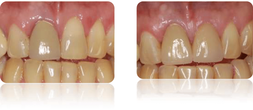 All Ceramic Crowns discount dental plan