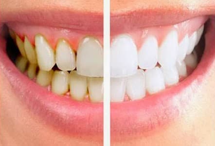 How To Avoid Coffee Stains On Teeth