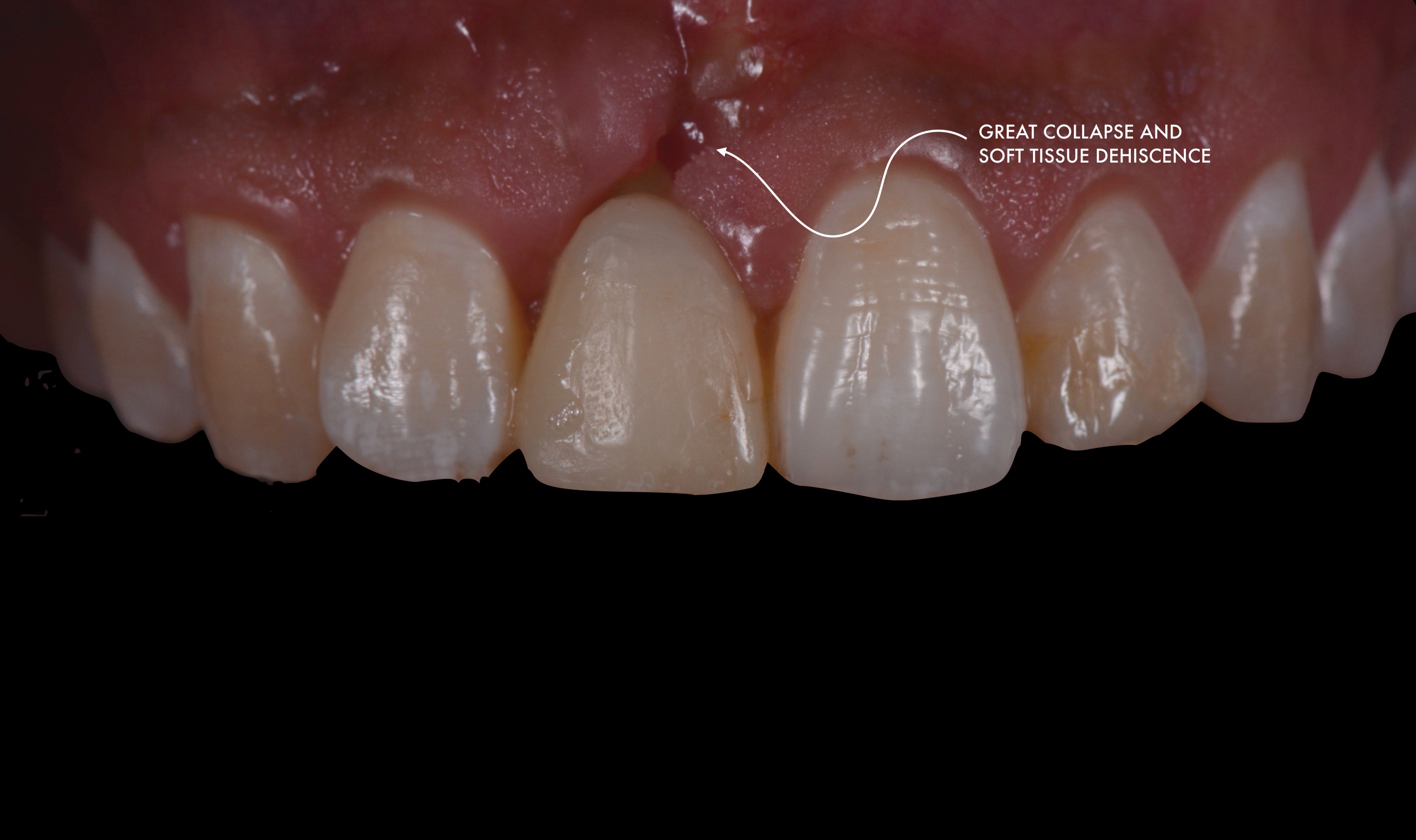 IMPLANT PLACEMENT IN THE AESTHETIC ZONE WITH IMMEDIATE LOADING AND