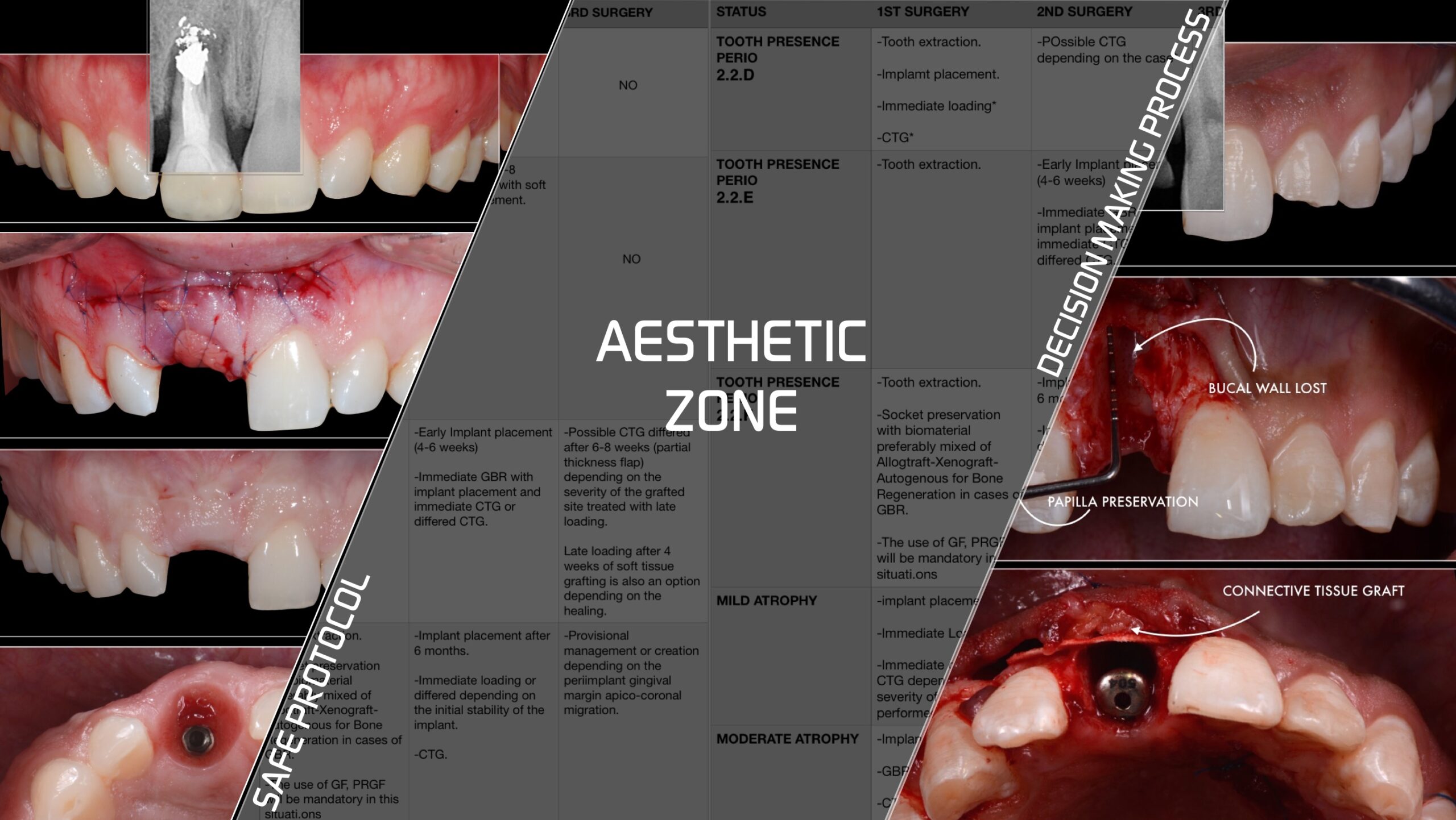 Decision making process for predictable implant placement in the