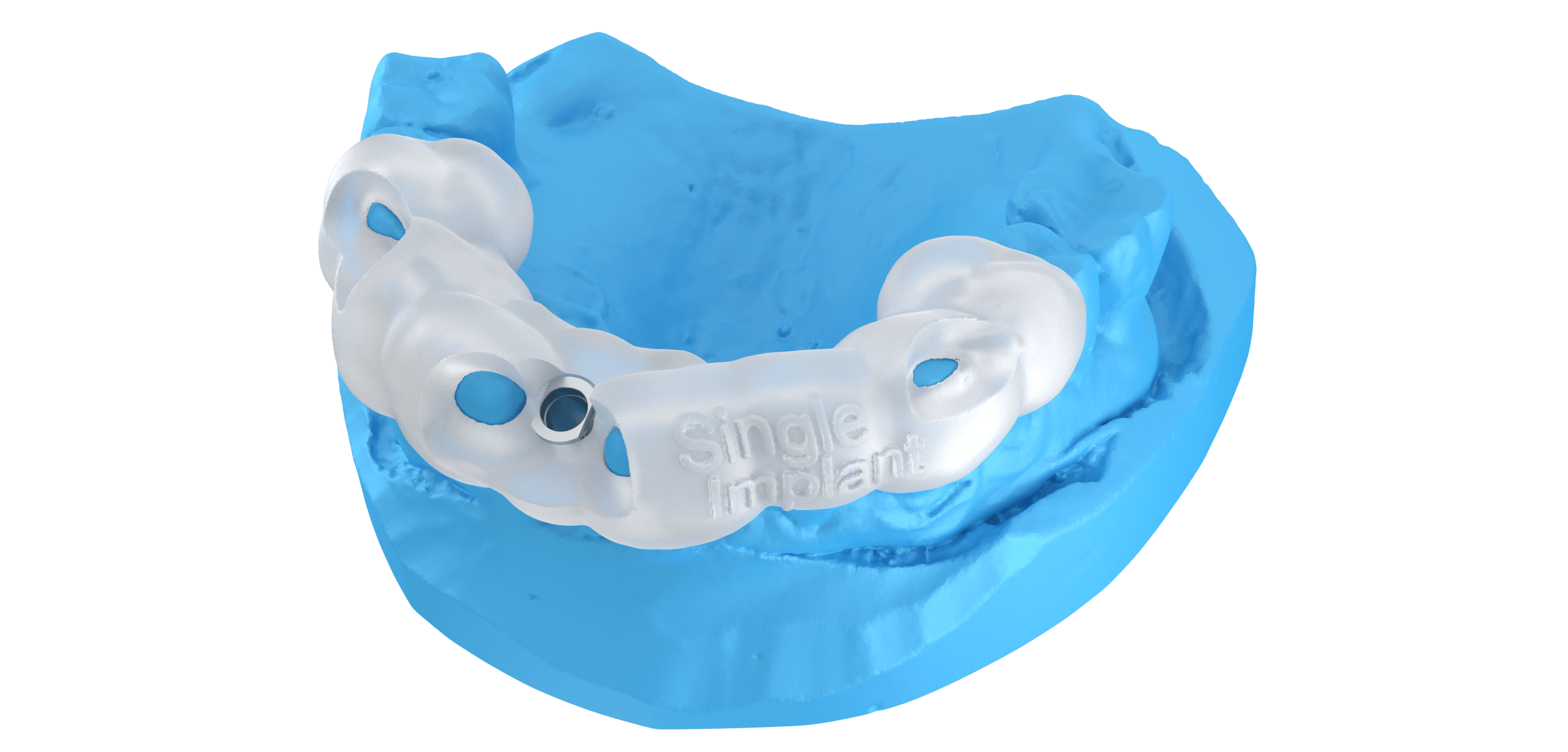 single implant Dental Wings