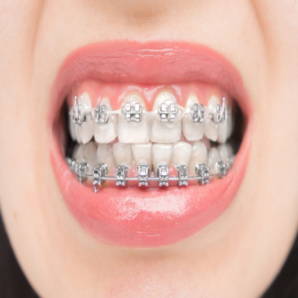 Brackets dentales DENTAL XPLENDER
