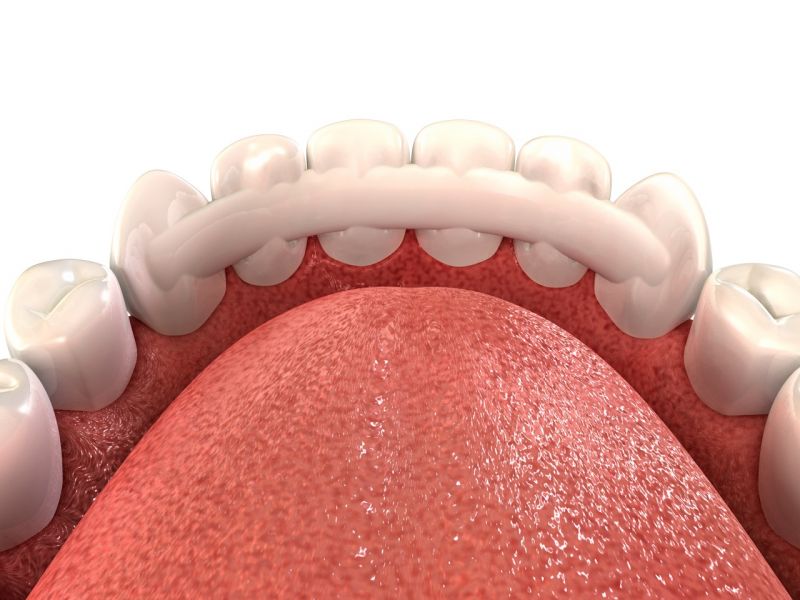 Dentapreg Ortho Retention