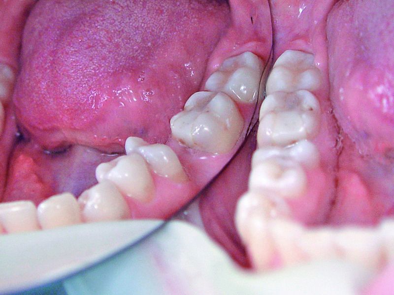 Dentapreg Posterior Bridge