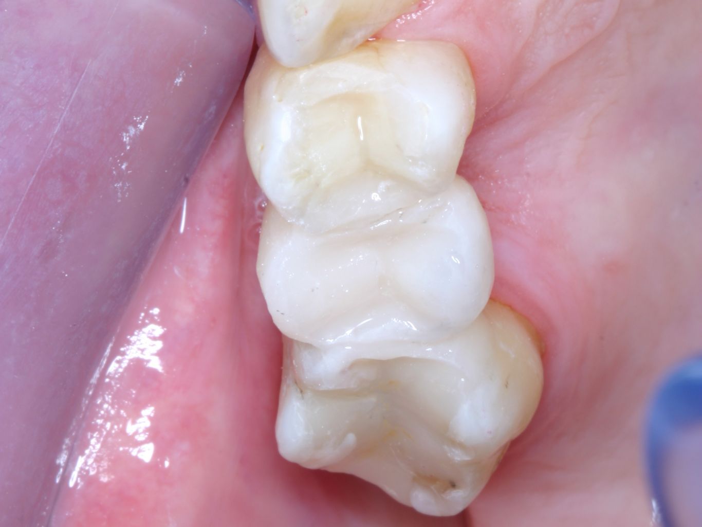 Dentapreg Posterior Bridge