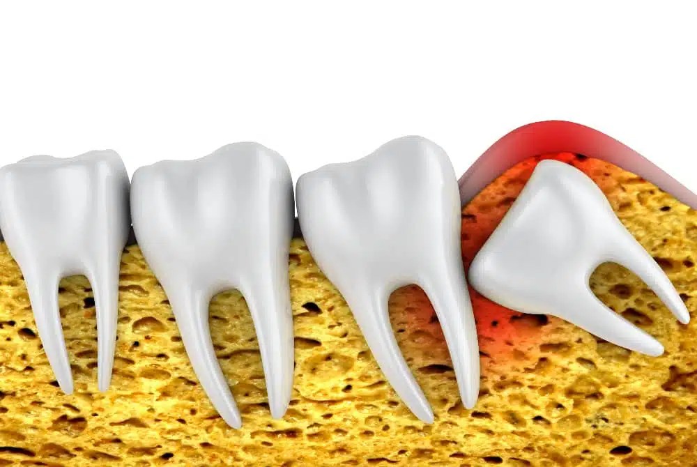 Wisdom Tooth Extraction in Turkey Cost & Treatment Abroad Page 2 of 2