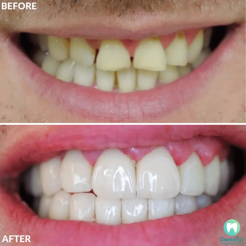 Zirconium Veneers In Turkey Benefits Dentatur