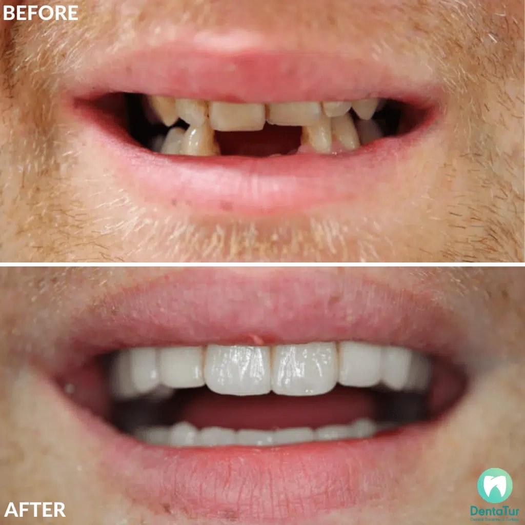 How to mentally prepare for dental implant surgery Dentatur