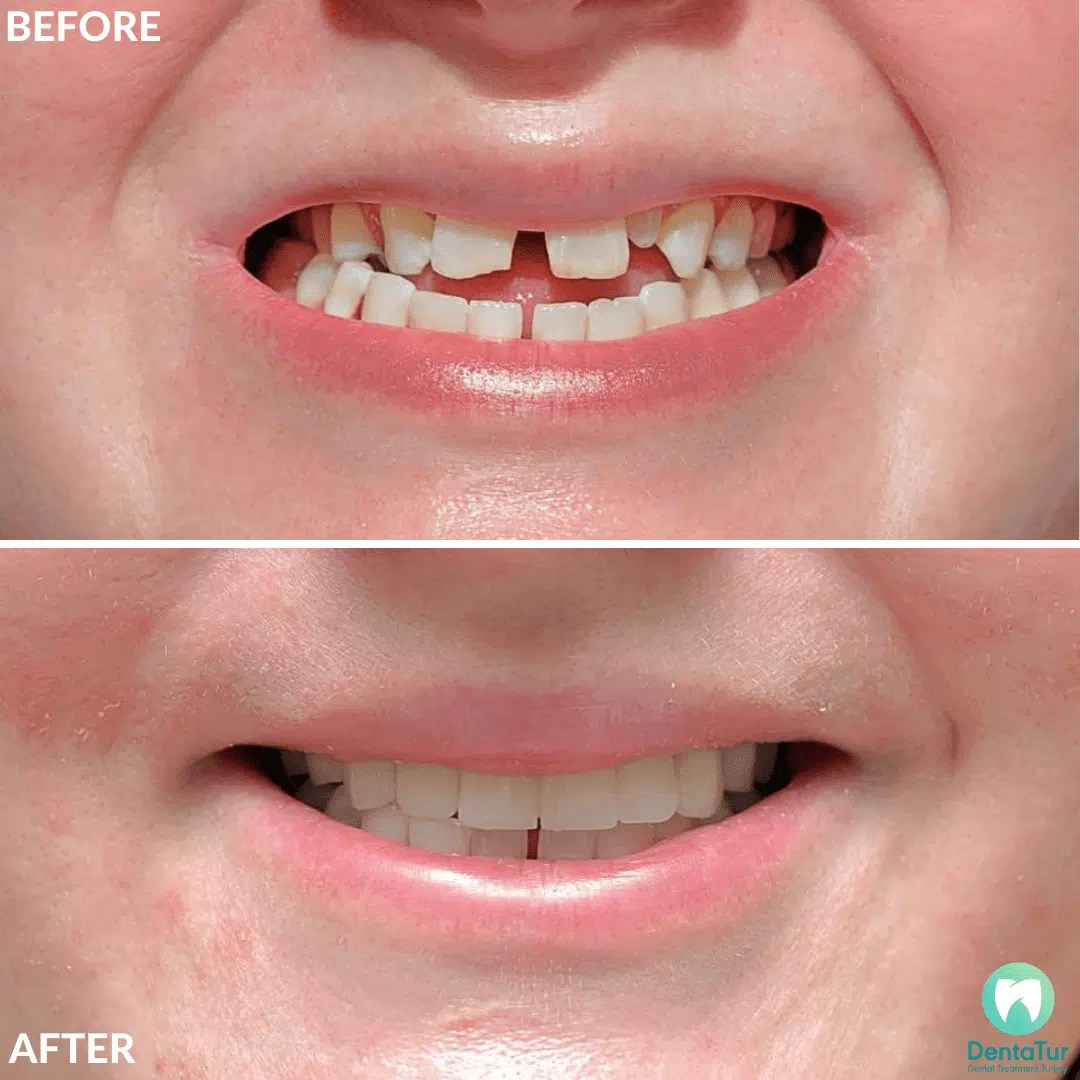 Allon6 Dental Implants in Turkey prices, packages, procedure