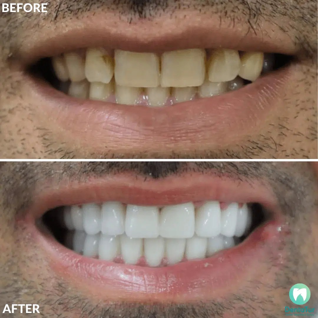 Laminate Veneers in Turkey Cost and Benefits