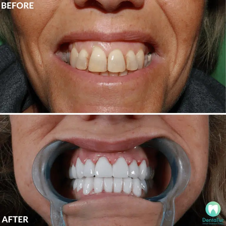 What to know about gum graft surgery Dentatur