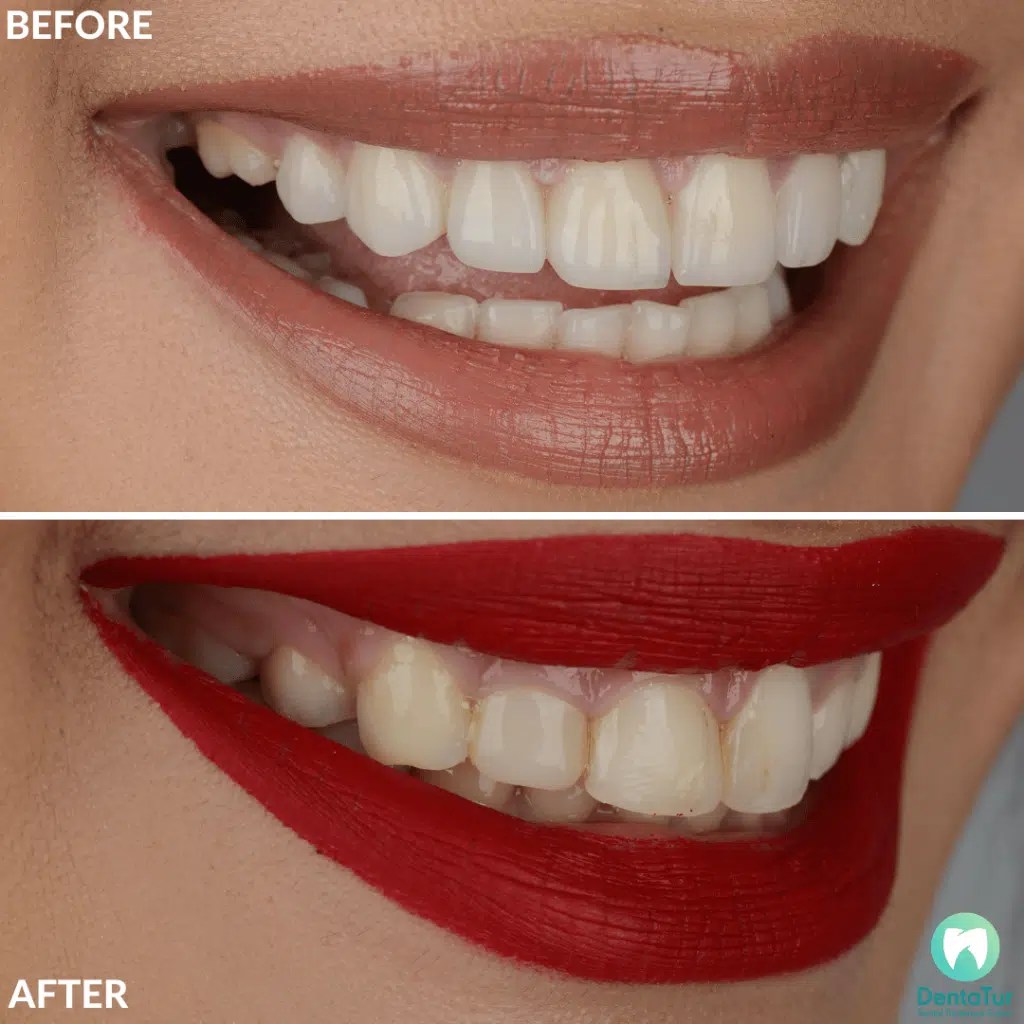 Best Dentist at the Dentatur Dental Clinic in Antalya