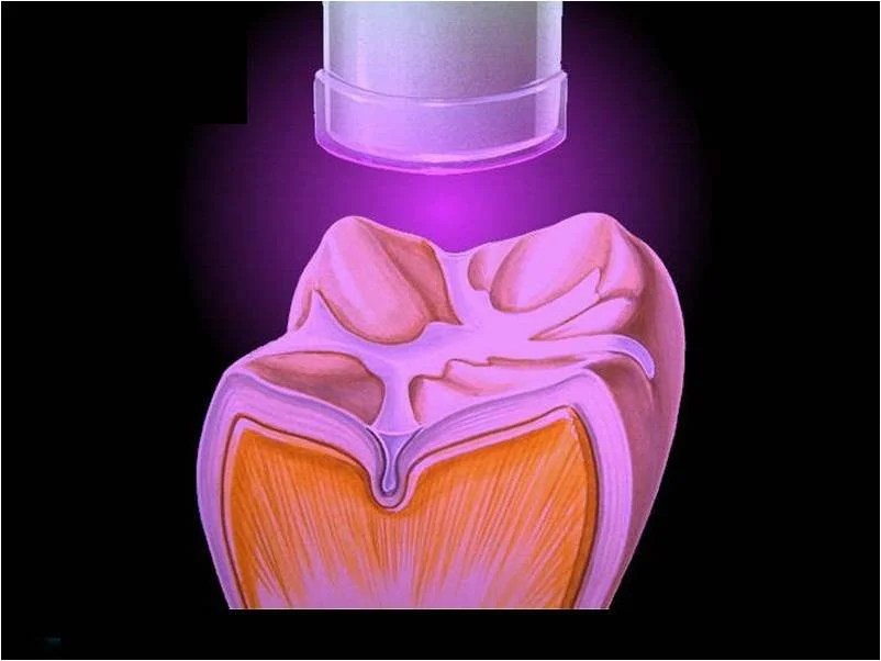 Dental Sealants One of the Most Advanced Digital Dentistry and Dental