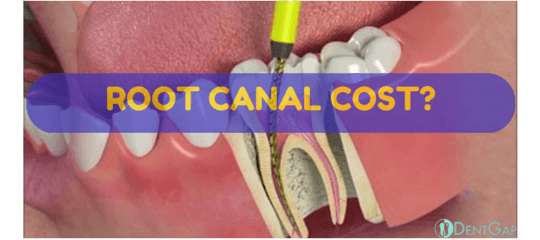 Root Canal Cost Ways to Get Discount up to 50