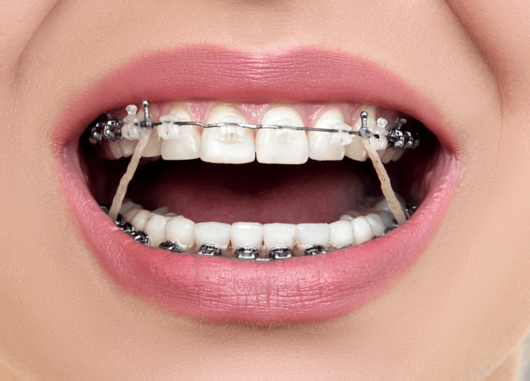 orthodontie Saint Denisseparator_saDentilay