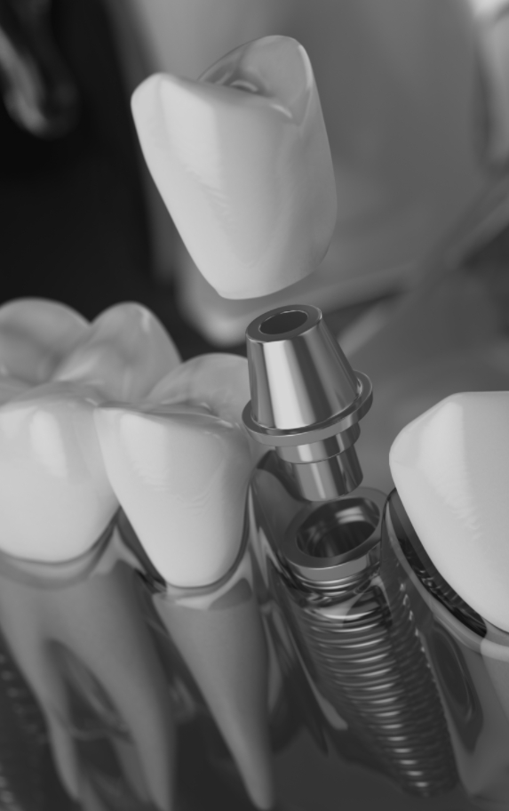 Implant Dentistry Dentince