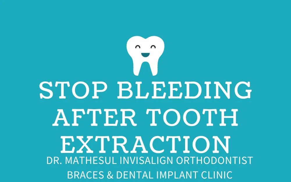 How To Stop Bleeding After Tooth Extraction