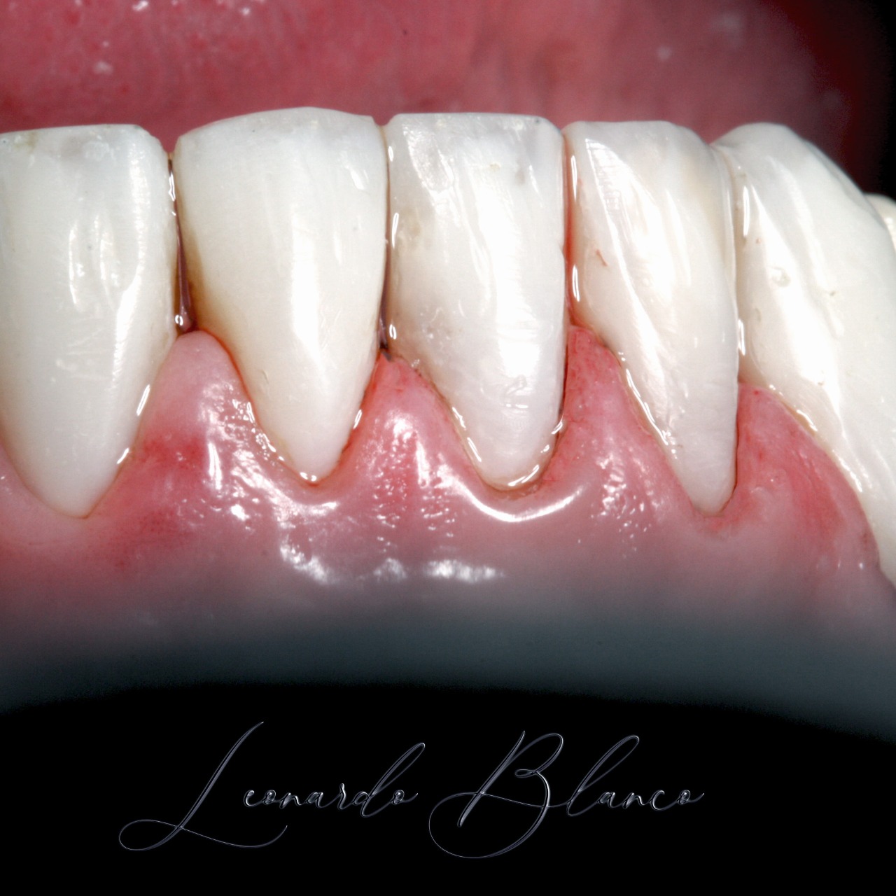 Implante dentário Maringá Dentista Maringá Zona 04