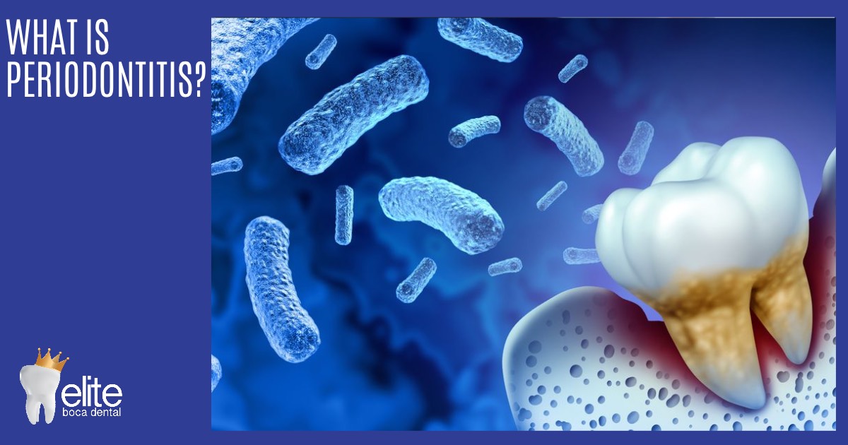 What is Periodontitis Elite Boca Dental