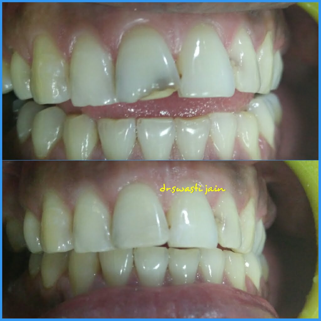 Cosmetic Fillings / Tooth Filling Senior Dentist in Vaishali