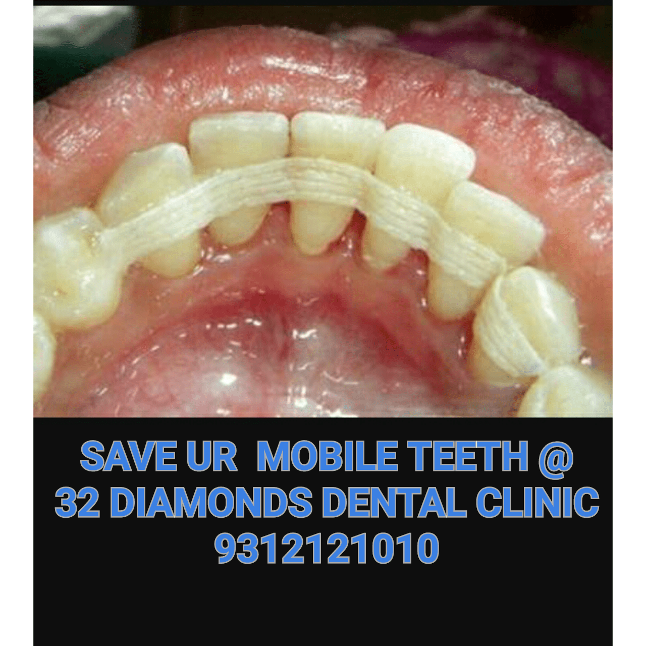 Treatment of Mobile Tooth / Splinting Senior Dentist in Vaishali