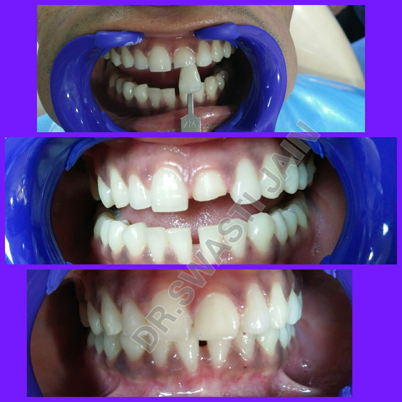 Cosmetic Fillings / Tooth Filling Senior Dentist in Vaishali
