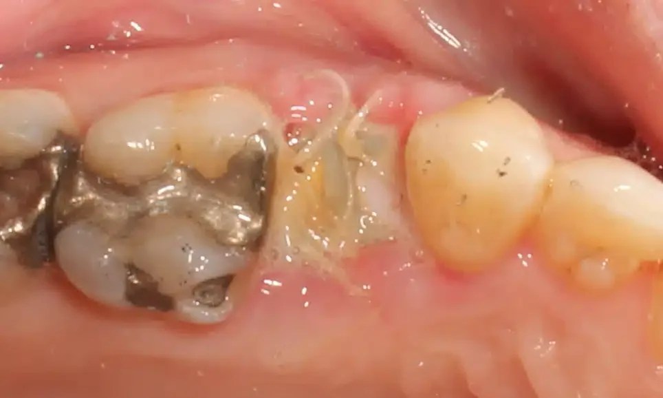 What happens if you don’t get a bone graft after tooth extraction