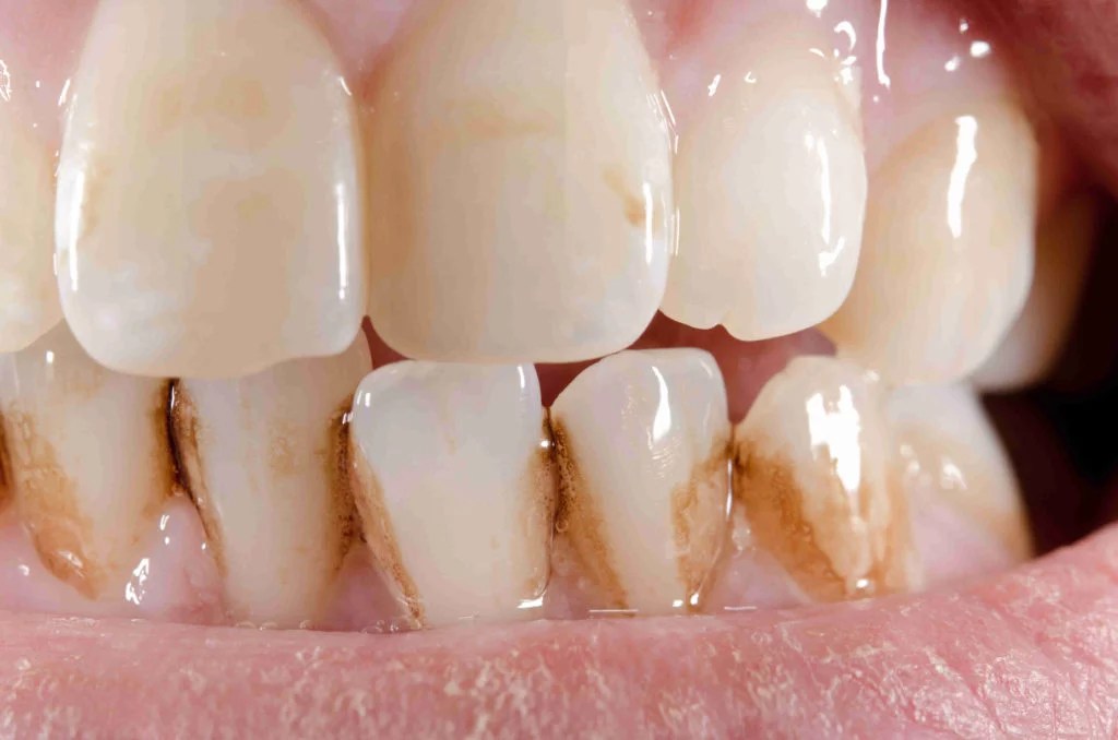 How to Remove Stains Between Teeth Expert Tips for Whitening and