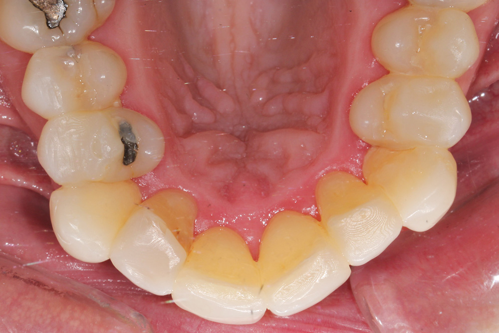 Composite Bonding Northern Ireland Dentistry Markethill