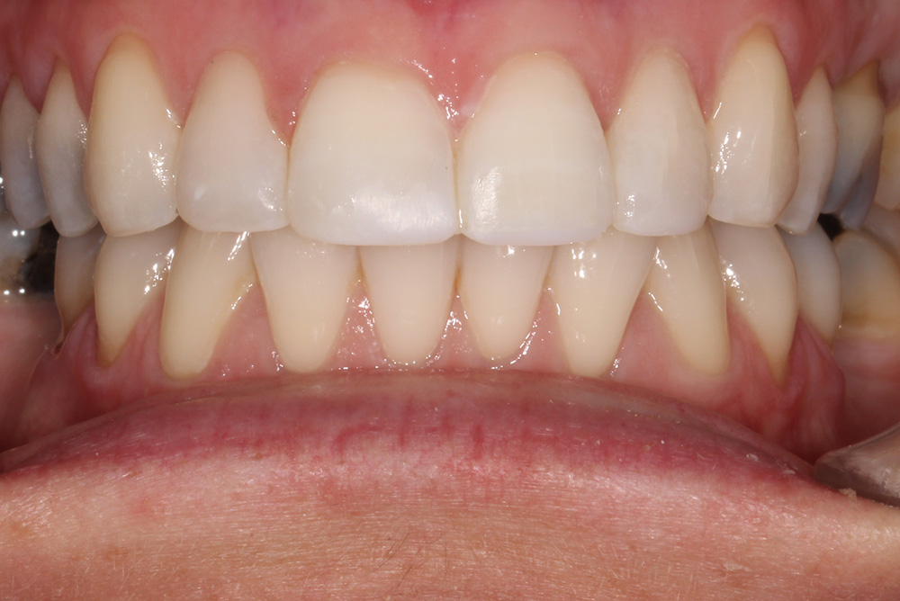 Composite Bonding Northern Ireland Dentistry Markethill