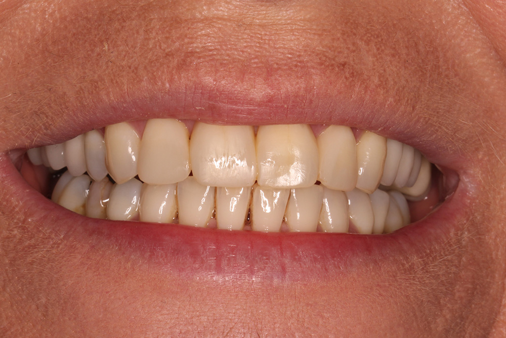 Composite Bonding Northern Ireland Dentistry Markethill