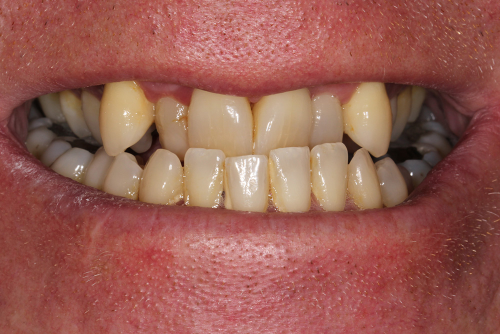 Composite Bonding Northern Ireland Dentistry Markethill