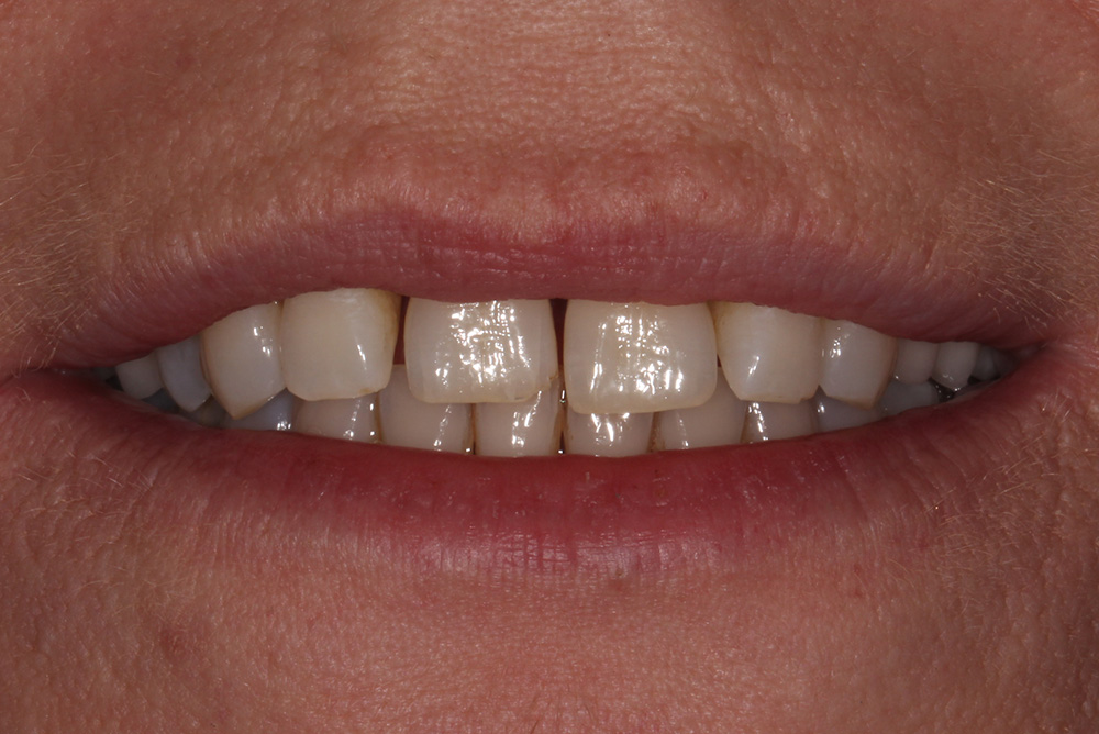 Composite Bonding Northern Ireland Dentistry Markethill