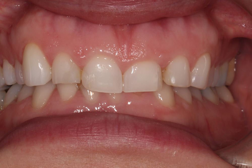 Composite Bonding Northern Ireland Dentistry Markethill